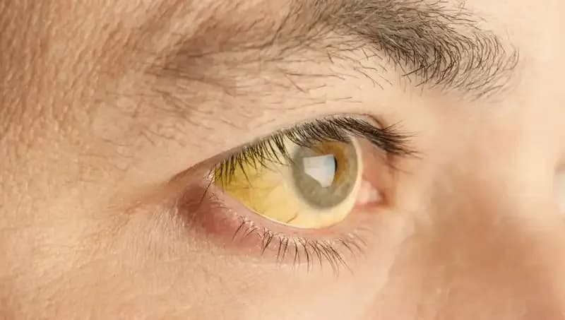 Gözlerinize Dikkat Edin: Karaciğer Sağlığınız Hakkında Bilmeniz Gerekenler