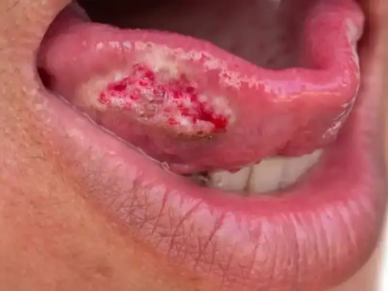 36 Yaşındaki Kadın Migreni İle Başlarken Kanserle Savaşmak Zorunda Kaldı