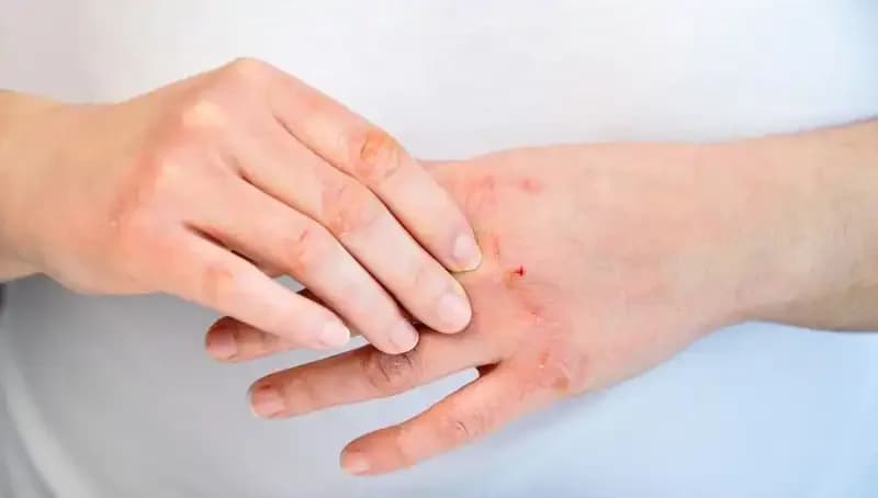 Yetersiz Protein Tüketiminin Belirtileri: 6 İşaretle Dikkat Çekin!