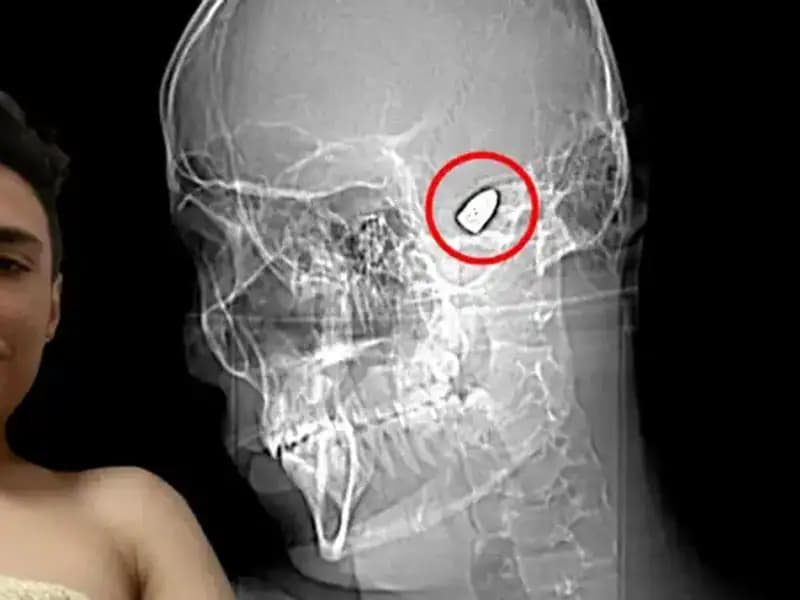Kafasında Patlayıcıyla Dolaşan Adamın Şok Edici Hikayesi